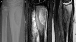 Patient 5. Lesion in distal 1/3 of the radius. (A) X-ray showing well-defined radiolucent image in distal 1/3 of the radius with areas of sclerosis. (B) and (C) the MRI shows a lesion with a mixed-type intraosseous component, with lytic areas and other areas which seem to relate to bone formation, and adjacent soft tissue oedema.