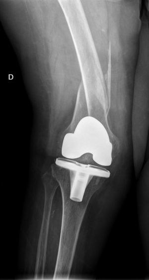 Interprosthetic fracture IIA (Platzer's classification).