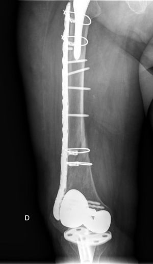 Interprosthetic fracture resolution IIA.