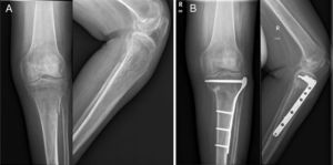 (A) Antero-posterior and lateral radiography of a right tibial plateau fracture 41.B1. (B) Synthesis using lateral plate with locking screws; very good outcome according to Schmeiser et al. criteria.