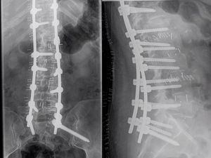 Second and third most common reasons for intervention: deformity (22%) and lumbar discopathy (21%).