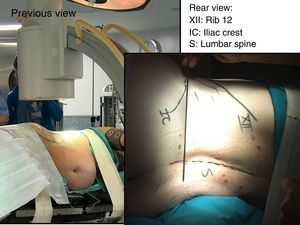 Surgery undertaken with the patient in a lateral position, on a radiotransparent with a break at the lumbosacral area.
