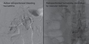 Large retroperitoneal haematoma due to active bleeding (left) treated by the vascular surgery department controlling the bleeding (right).