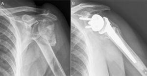 (A) Proximal humeral fracture in 4 fragments in a 74-year-old patient. (B) Postoperative follow-up at one year.
