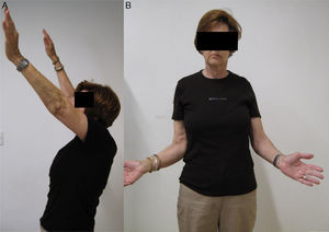 Mobility at 1 year. (A) In anterior flexion. (B) In external rotation.