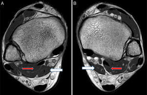 (A) and (B) MRI axial slices in the right and left ankle. ADLF muscle (white arrows) inside the tarsal tunnel, posteromedial to the neurovascular packet and medial to the FHL (red arrows). The colour of this figure is only visible in the electronic version of this paper.