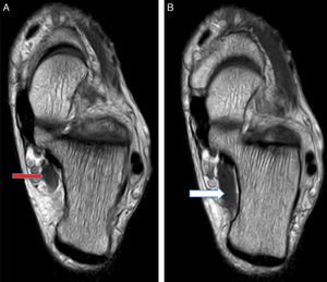 (A) and (B) MRI axial slices of the left ankle. (A) The trajectory of the ADLF in the tarsal tunnel (red arrow). (B) Insertion of the ADLF in the square plantar muscle (white arrow). The colour of this figure is only visible in the electronic version of this paper.
