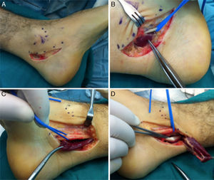(A) Medial incision in the left ankle. (B) and (C) Deep dissection, isolating the lateral plantar branch of the tibial nerve and identifying the muscle portion of the ADLF in the tarsal tunnel of the left and right ankles, respectively. (D) Distal disinsertion and proximal reflection of the ADLF muscle that makes it possible to visualise the flexor digitorum comunis tendon (FDC).