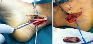 (A) The three branches of the tibial nerve are isolated. (B) Complete resection of the ADLF muscle.