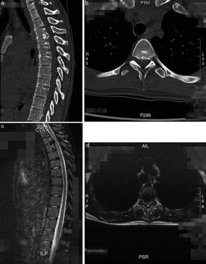 a–d. Case 1: Preparatory CT and MRI images that show the calcified T3–T4 hernia.