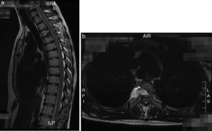 a and b. Case 1: Control MRI of the hernia resection.