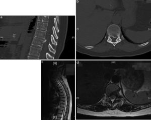a–d: Case 2: Control of the T10–T11 hernia resection using CT and MRI.