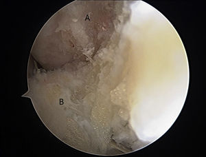 Preparation of ATFL insertion in the fibula; the bony landmark is debrided through the anterolateral portal.