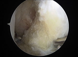 The remainder of the ATFL is pierced, from lateral to medial, with a Micro Suture Lasso (Arthrex, Naples, FL, USA).
