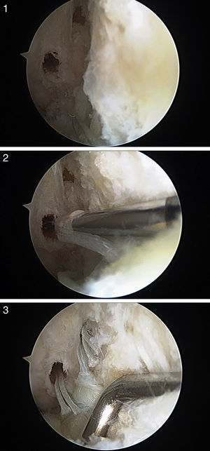 (1) Drilling of two openings, located vertically in the bony landmark; (2) the most distal suture point is passed through a 2.5-mm Biopush Lock knotless anchor (Arthrex, Naples, FL, USA) and inserted into the first hole; (3) 2 implants are used, because they allow a greater surface contact of the ATFL with the fibular bony landmark, as well as better tension distribution, from the biomechanical point of view.