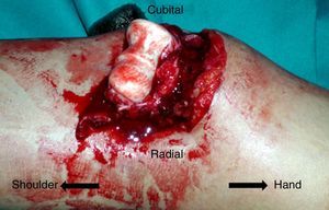 Clinical image of open elbow dislocation. Observe the exposure of the entire humeral palette through the skin.