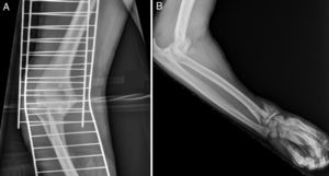 X-ray of the elbow dislocation and ipsilateral distal radius fracture; (A) antero-posterior projection; (B) lateral projection.