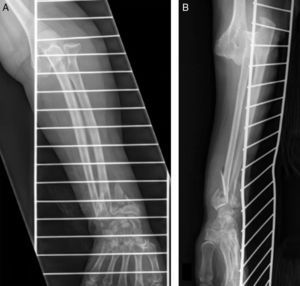 X-ray of elbow dislocation and of the ipsilateral distal radius fracture; (A) antero-posterior projection; (B) lateral projection.