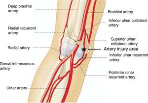 Location of the vascular injury when a posterior dislocation of the elbow by extension occurs (*). A force of greater magnitude and maintained over time may also but the brachial artery (arrow).