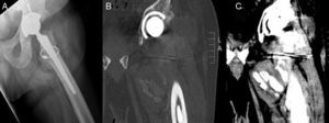 Periarticular calcifications can be seen on the X-ray (A) and CAT scan (B, C). No signs of loosening.