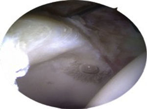 Intra-operative image of the right hip from the anterolateral portal with acetabular cartilage lesion, detached from bone with intact periphery (bubble).
