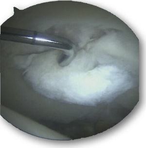 Intra-operative image of the right hip from the medioanterior portal with acetabular cartilage lesion and exposed bone. Instrument introduced through the anterolateral portal.