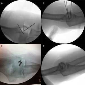 (a) Anteroposterior projection of the elbow: verification of the correct placement of the Kirschner needles using fluoroscopy. (b) Lateral projection of the elbow. (c) Lateral projection of the elbow: verification of the correct placement of the cannulated screws using fluoroscopy. (d) Anteroposterior projection of the elbow.