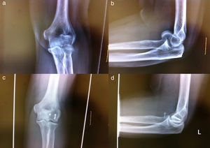 (Case 1) (a) Anteroposterior radiological projection of the elbow. (b) Radiological projection of the elbow in profile. (c) Anteroposterior radiological projection of the elbow 36 months after surgery. (d) Radiological projection of the elbow in profile 36 months after surgery (it is possible to observe a calcification in the anterior area of the elbow that does not interfere in its functionality).