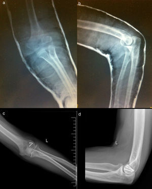 (Case 2) (a) Anteroposterior radiological projection of the elbow. (b) Radiological projection of the elbow in profile. (c) Anteroposterior radiological projection of the elbow 26 months after surgery. (d) Radiological projection of the elbow in profile 26 months after surgery.