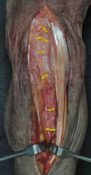 Dissection showing the posterior interosseous nerve and its trifurcation at the level of the joint capsule into three proprioceptive branches. Author's dissection obtained in collaboration with the Laboratory of Macro- and Microdissection and Surgical Anatomy at the University of Barcelona, Hospital Clínico (Director: Dr Manuel Llusa).