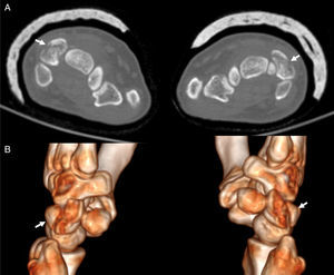 (A) Axial CT image at the level of the first row of the carpal bones and reconstruction. (B) 3D CT image (B) of both wrists that confirmed the dorsal fracture of both triquetral bones (arrows).