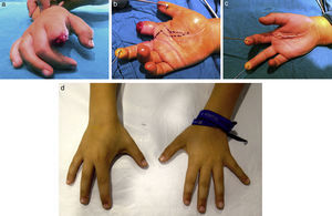 (a) Traumatic amputation following animal bite. (b) Surgical image with skin flap design. (c) Postoperative image. (d) Clinical appearance after 5 years evolution.