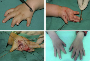 (a) Ray deficiency associated with syndactyly. (b) Intraoperative image. (c) Postoperative image. (d) Clinical results after 5 years evolution.