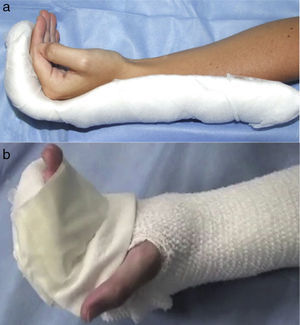 (a) Postoperative dorsal splint to stop metacarpophalangeal extension at 70° and proximal and distal interphalangeals at 0°. (b) Immobilisation of the interphalangeals in extension while the patient is not performing any exercises.