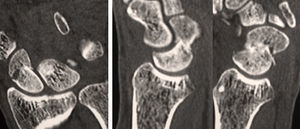 46-year-old male. Non-dominant left wrist. Eleven months since the trauma. CT image in which the humpback deformity can be seen.