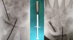 Defect created in the scaphoid, placement of the distal radio distal using an insulin syringe as a trocar, and intraoperative result with the fixation screw.