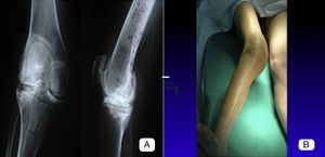 Preoperative images of a patient with a valgus deformity of 23°. (A) We can see the preoperative planning in the image with the X-rays taken in the anteroposterior and lateral planes over which the cuts and resection angles have been drawn. (B) The image shows the appearance of the limb prior to surgery.
