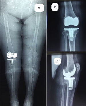 Postoperative images of the patient shown in Fig. 1A after 10 years. Teleradiography of lower limbs, weight-bearing, with valgus alignment of 6°. (B) Weight- bearing X-ray on anteroposterior plane. (C) Weight-bearing X-ray on lateral plane.