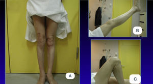 Postoperative images at 10 years of the patient shown in Figs. 1 and 2. (A) Standing anteroposterior view of both limbs. (B) Lateral view in 45° hip flexion and maximum knee extension at 0°. (C) Lateral view 125° knee flexion.