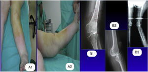 (A) Preoperative images of a case with 27° valgus taken in the anteroposterior plane and recurvatum of 10° in the lateral plane, associated with severe instability on both planes. (B) Preoperative X-rays taken in the anteroposterior and lateral planes, and teleradiography of both lower limbs, with presurgical planning.