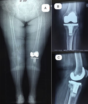 Postoperative images of the patient of Fig. 4 at 12 years after surgery. (A) Teleradiography of weight bearing lower limbs with a valgus alignment of 6°. (B) Weight-bearing X-ray, anteroposterior plane. (C) Weight-bearing X-ray, in the lateral plane.