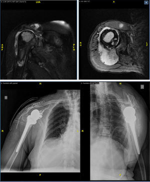 Top: 2 slices of magnetic resonance imaging prior to surgery, showing Hamada grade IV rotator cuff arthropathy with breakage and medial retraction to the acromioclavicular joint of the SE, major anterosuperior migration of the humerus head with large bone cysts and a large amount of intrajoint fluid, narrowing of the acromion, arthrosis of the acromioclavicular and glenohumeral joints. Bottom: X-ray result after RTSA implantation (Delta III-X-Tend Depuy-Synthes®).