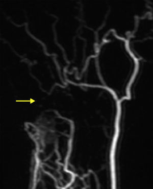 Angio-MRI after gadolinium injection: sharp detention of contrast flow in the ulnar artery at Guyon canal level. Radial artery porous leading to digital vascularisation.