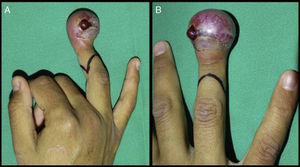 (A and B) The clinical appearance of the right ring finger, with highly compromised soft tissue and pain.