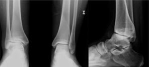 X-ray of ankle load.