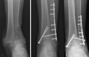 Sequence of luxation fracture, osteosynthesis and loss of reduction.