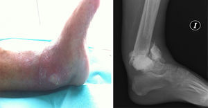 Medial ulcer, cellulitis and rupture of cement spacer.