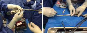 Preparation of cemented nail with silicone tubes.