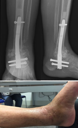 Detail of the tibiotalar fusion; note the cement surrounding the nail in the X-ray. Below, clinical image of healed ulcer and absence of signs of infection.