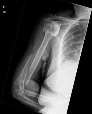 Extra-articular distal-third diaphyseal fracture of the humerus.